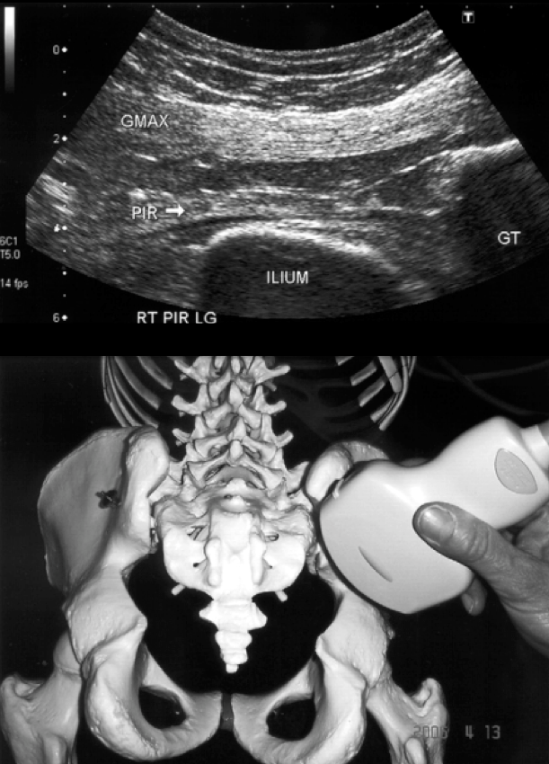 Ultrasound Guided Piriformis Muscle Injection Technical Guideline